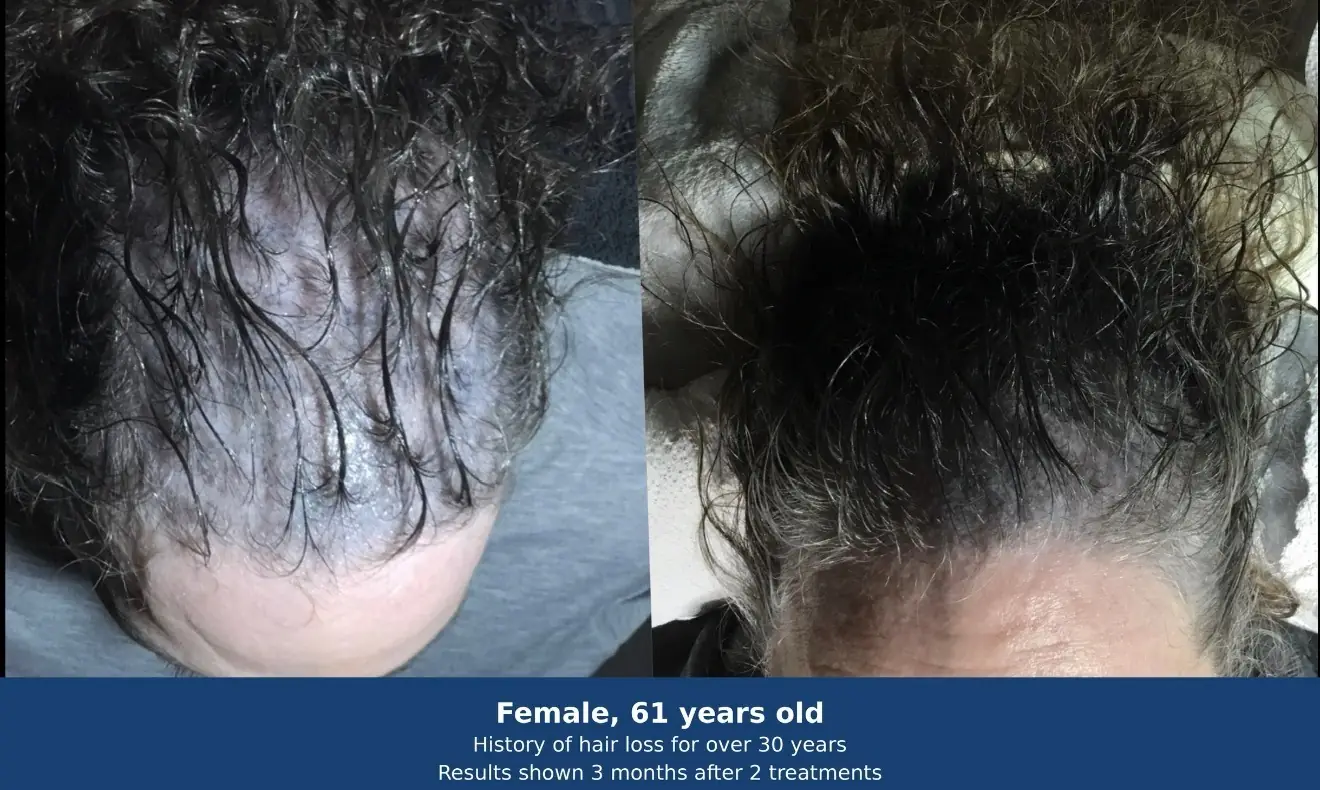 Hair regeneration before and after — female, 61