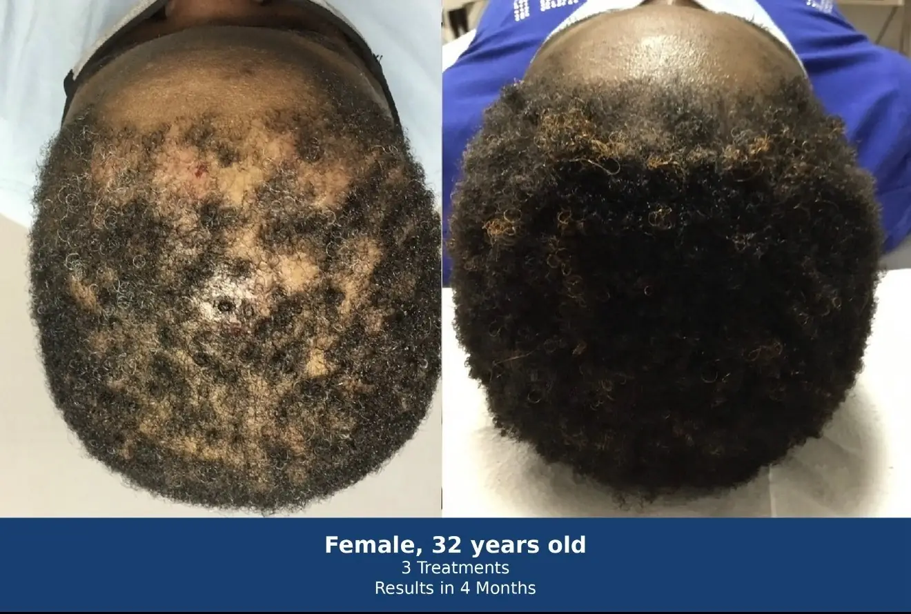 Hair regeneration before and after — female, 32