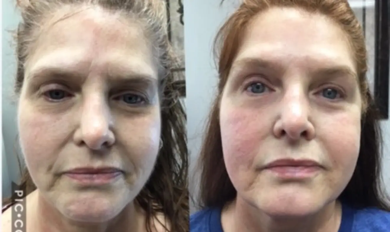 Ultherapy Prime facial lifting before and after