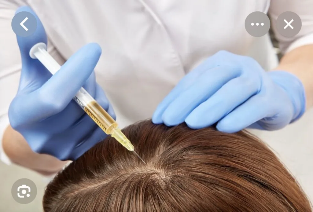 PRP therapy